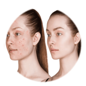 Pattanásos-Problémás bőrre